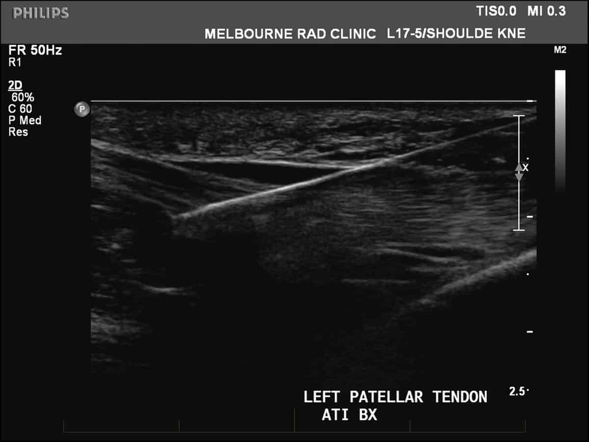 ATI biopsy left patellar tendon under ultrasound guidance