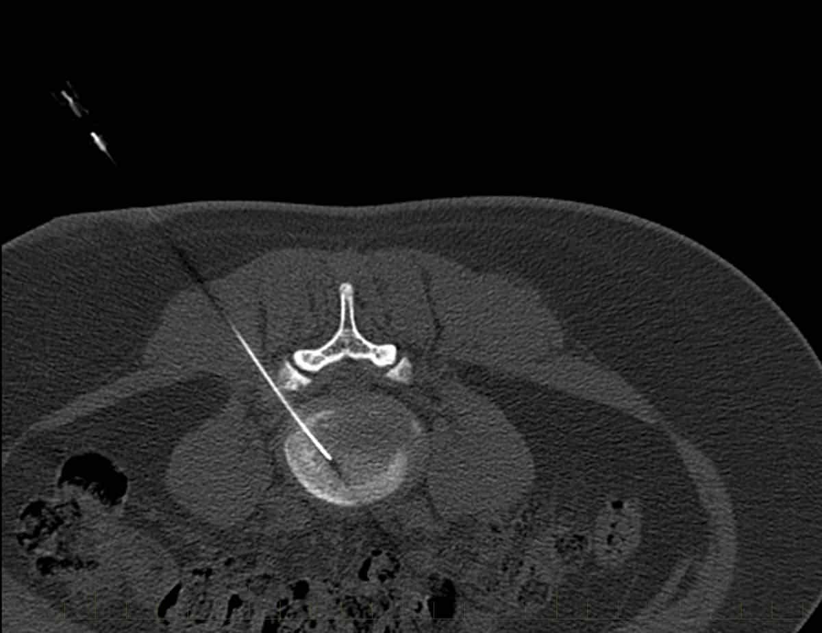 CT discogram (A). needle in target position within the L3/4 disc