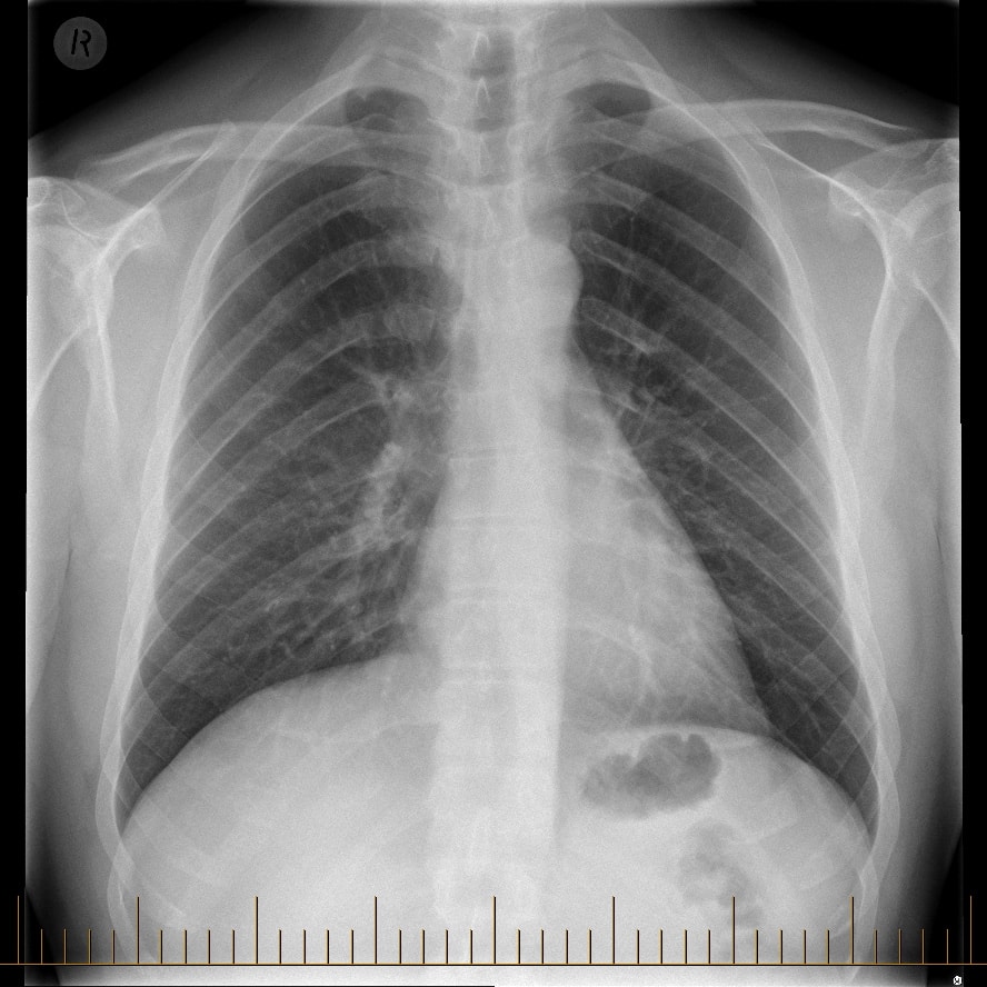 Digital X-ray Patient Fact Sheet | Melbourne Radiology