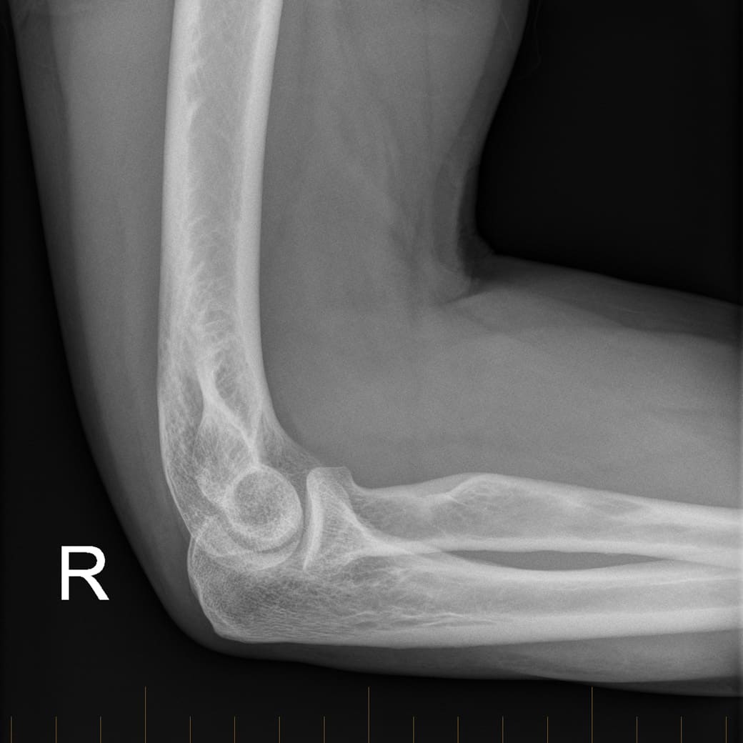 digital X-ray of the right elbow