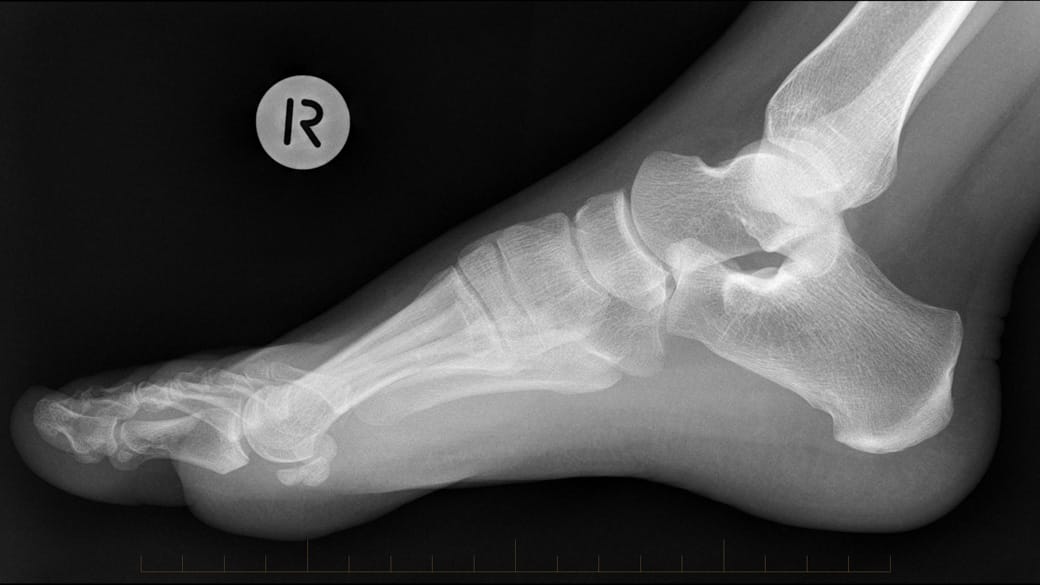 digital x-ray of a right foot