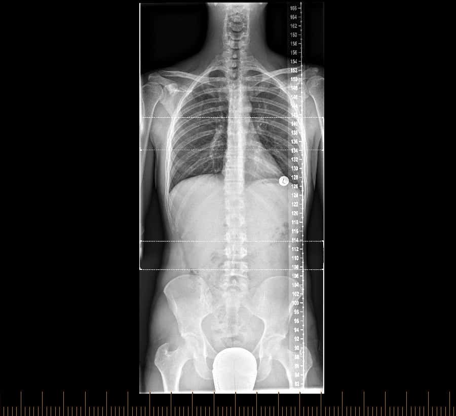 digital x-ray of the spine
