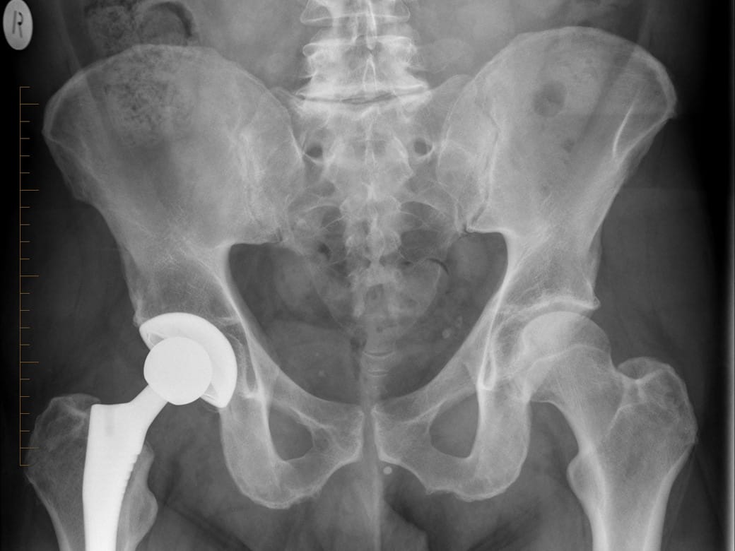 digital x-ray of a pelvis hip replacement
