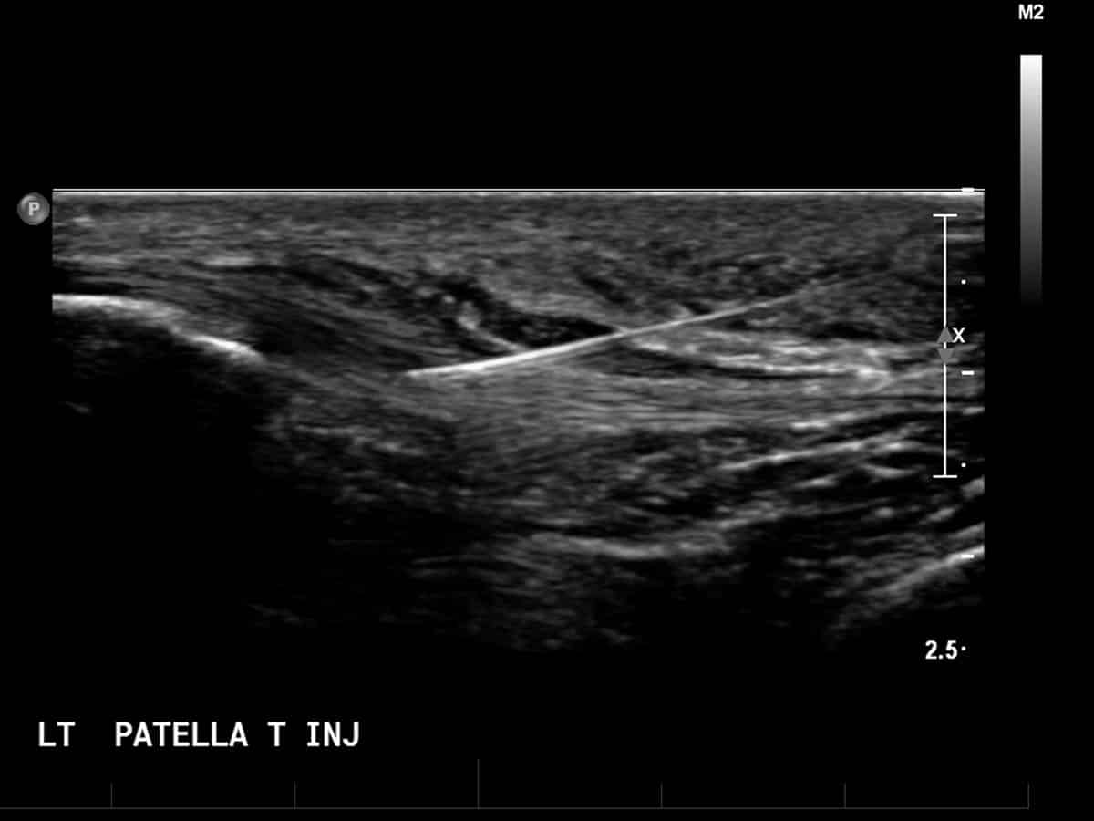 ultrasound of a polidocanol sclerosant injection