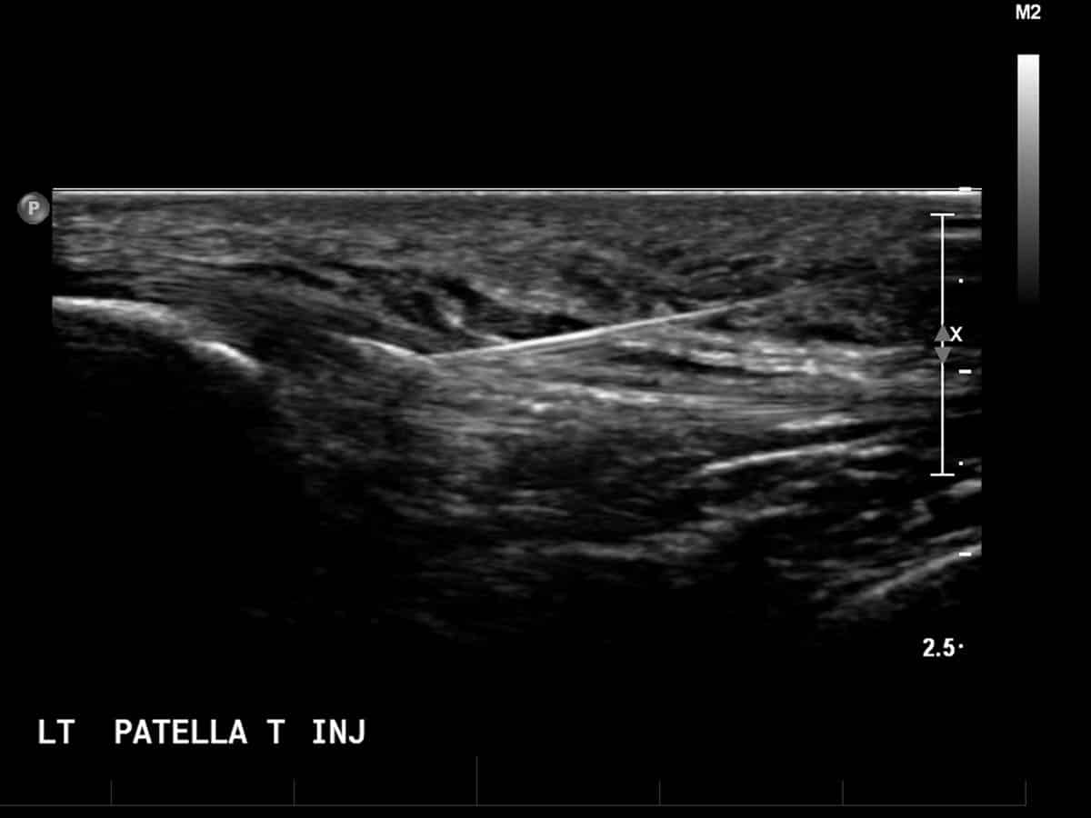 ultrasound image of a polidocanol sclerosant injection