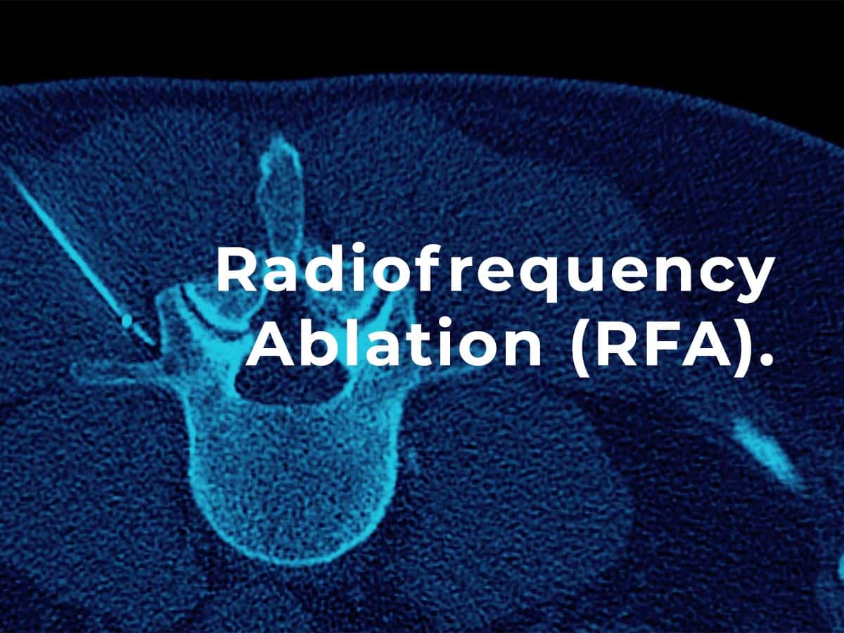 Radiofrequency Ablation (RFA) - Patient Guide