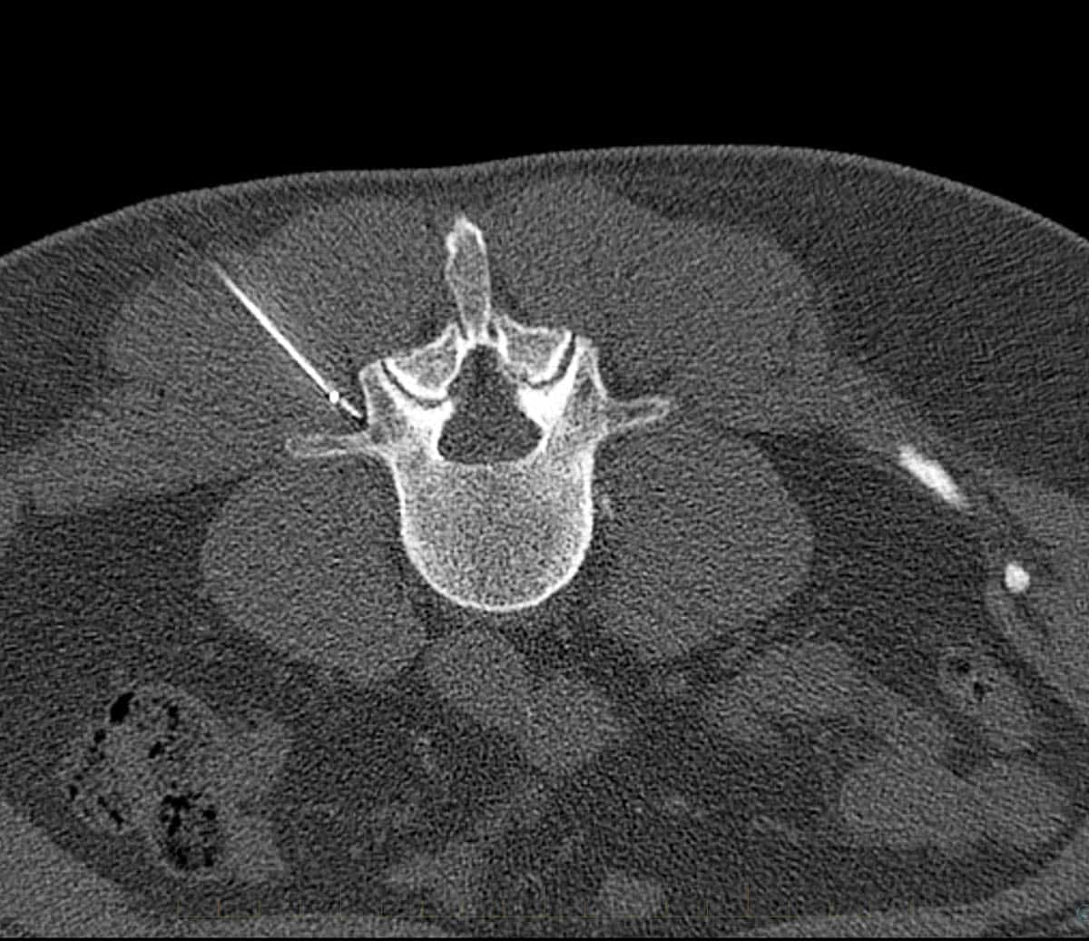 Radiofrequency Ablation (RFA) - Performed with CT imaging guidance to treat facet joint pain of lumbar spine Radiofrequency Ablation (RFA) - Performed with CT imaging guidance to treat facet joint pain of lumbar spine