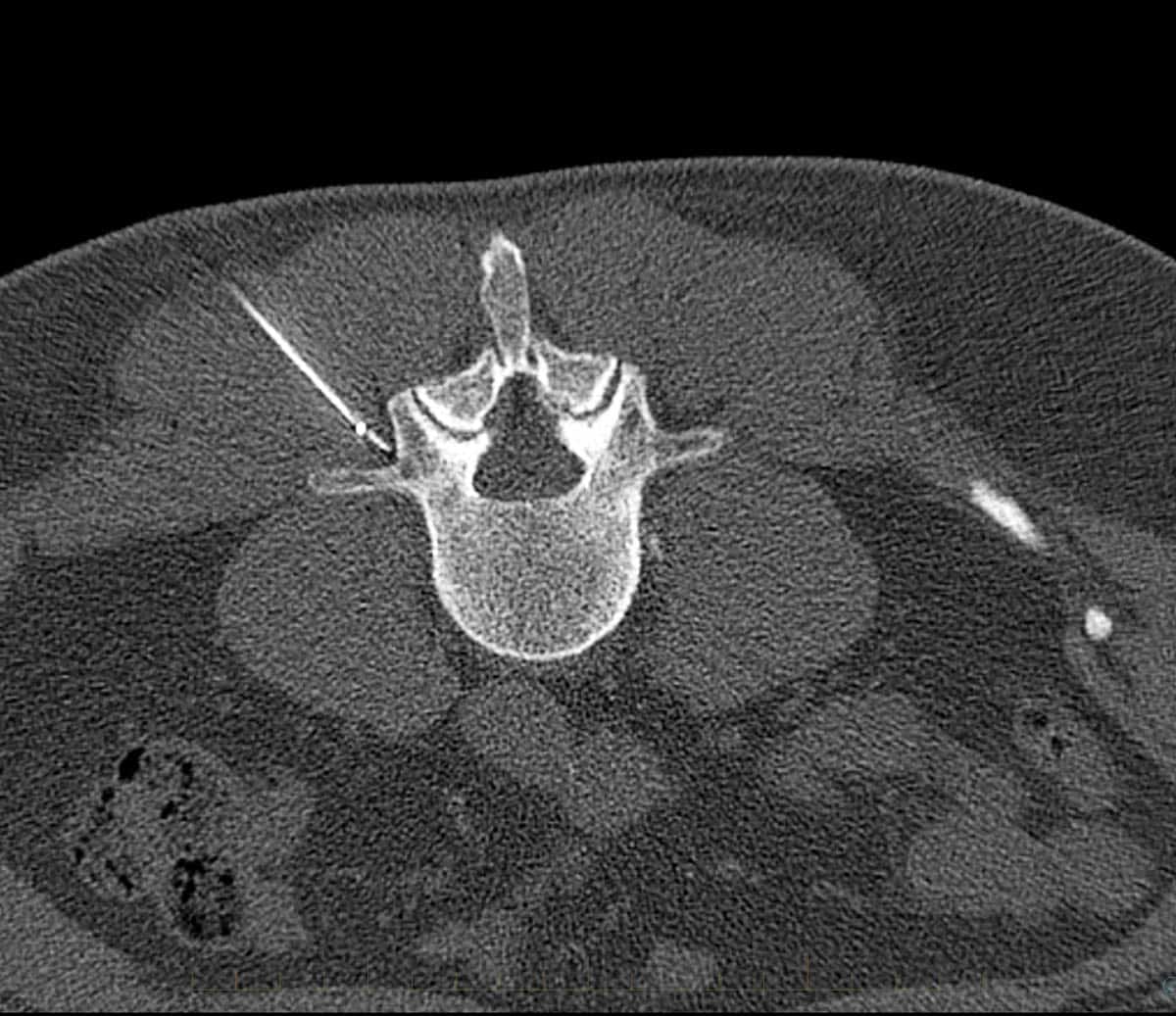 Radiofrequency Ablation (RFA) - Performed with CT imaging guidance to treat facet joint pain of lumbar spine