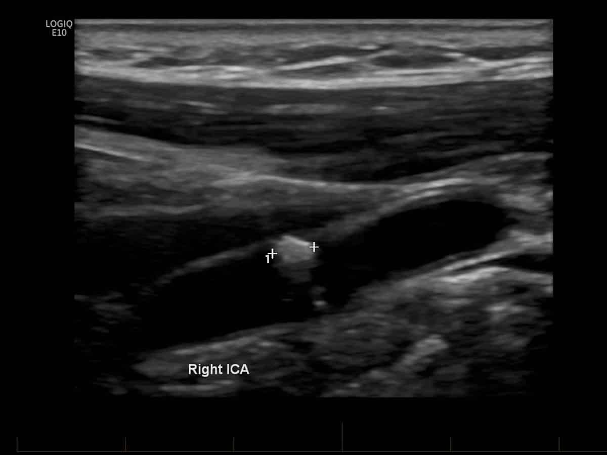 Ultrasound doppler - carotoid: Ultrasound of the carotid artery demonstrates an area of calcific plaque formation (clipers).