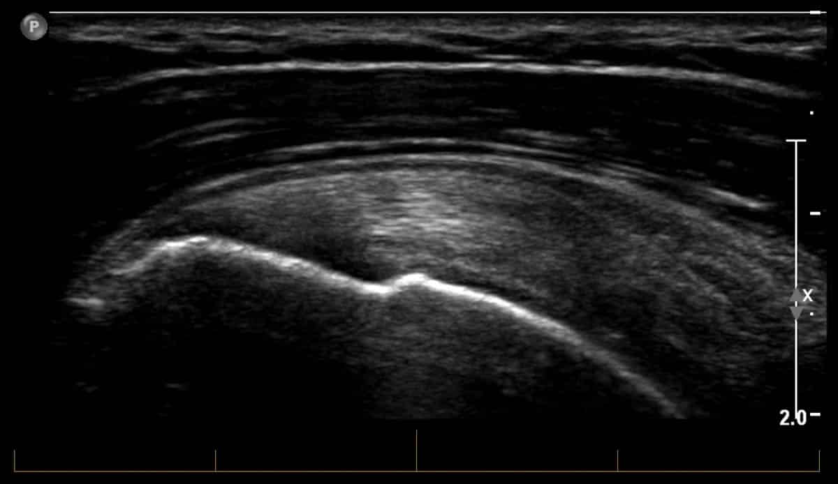 Ultrasound - MSK ultrasound of the shoulder