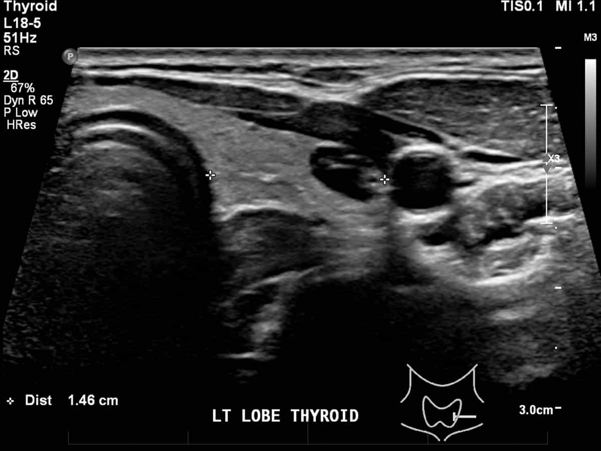 Ultrasound scan of left lobe of thyroid gland