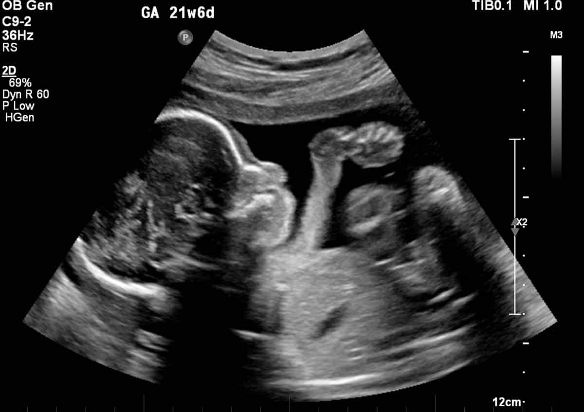 Obstetric Ultrasound - 2nd Trimester Pregnancy Scan at 21 weeks