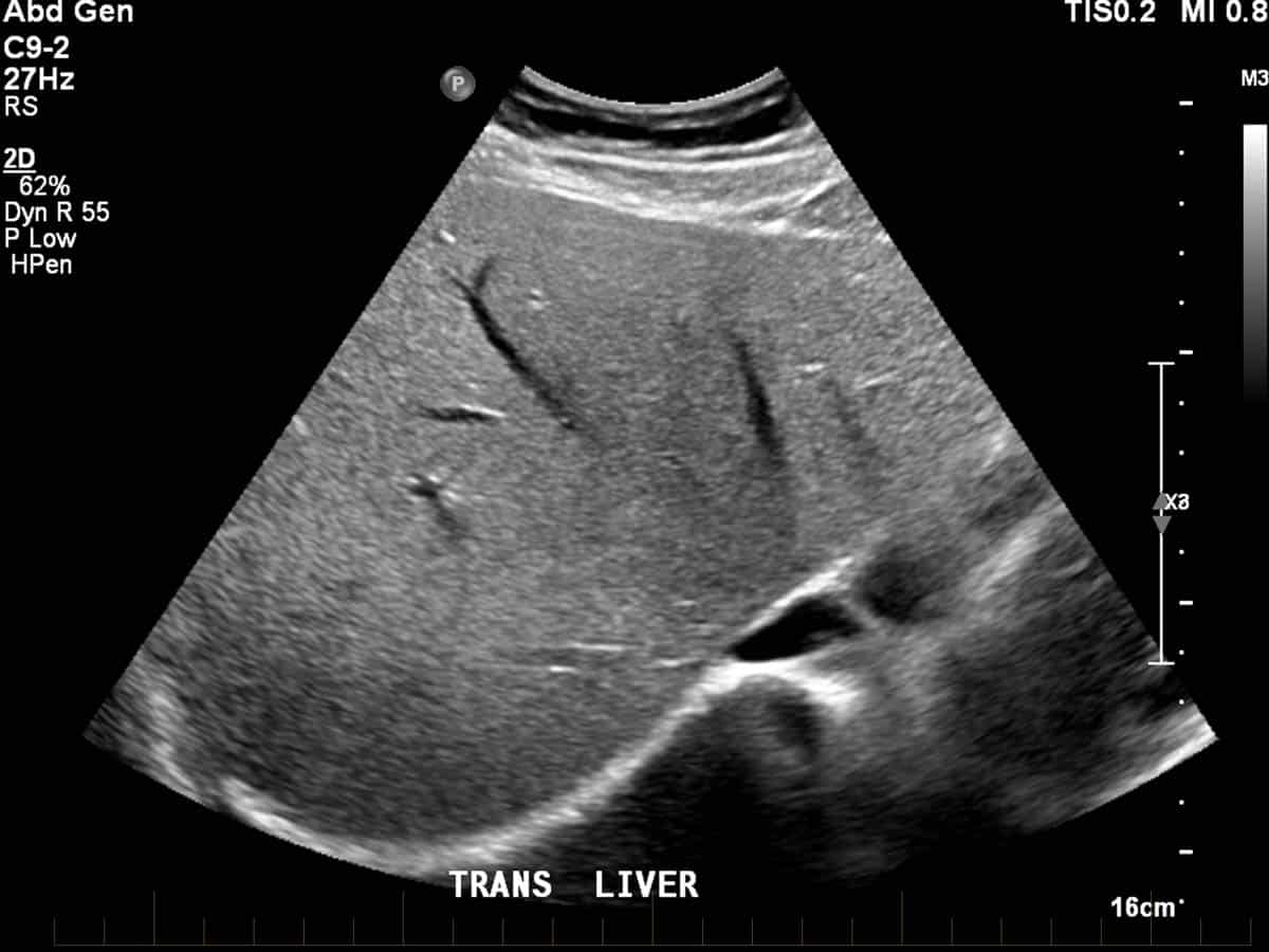 Ultrasound of abdomen demonstrating the liver - transverse view