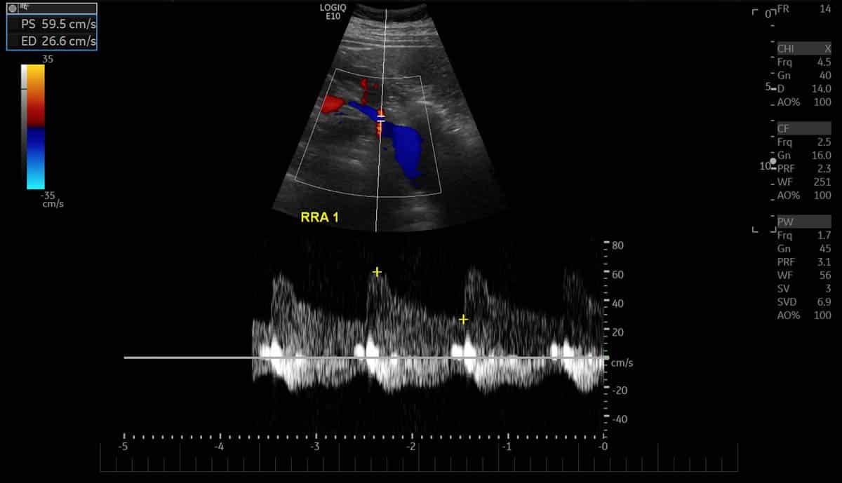 Renal Ultrasound - Colour doppler ultrasound examination of the right renal artery assessing flow within the vessel.