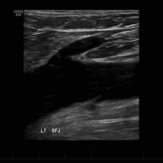 Ultrasound venous - varicose veins