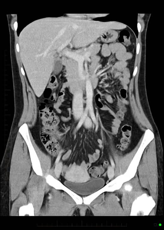 Ct Scan With Iv Contrast Patient Fact Sheet