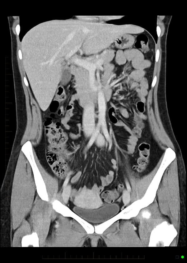 2. Routine contrast enhanced CT of abdomen and pelvis