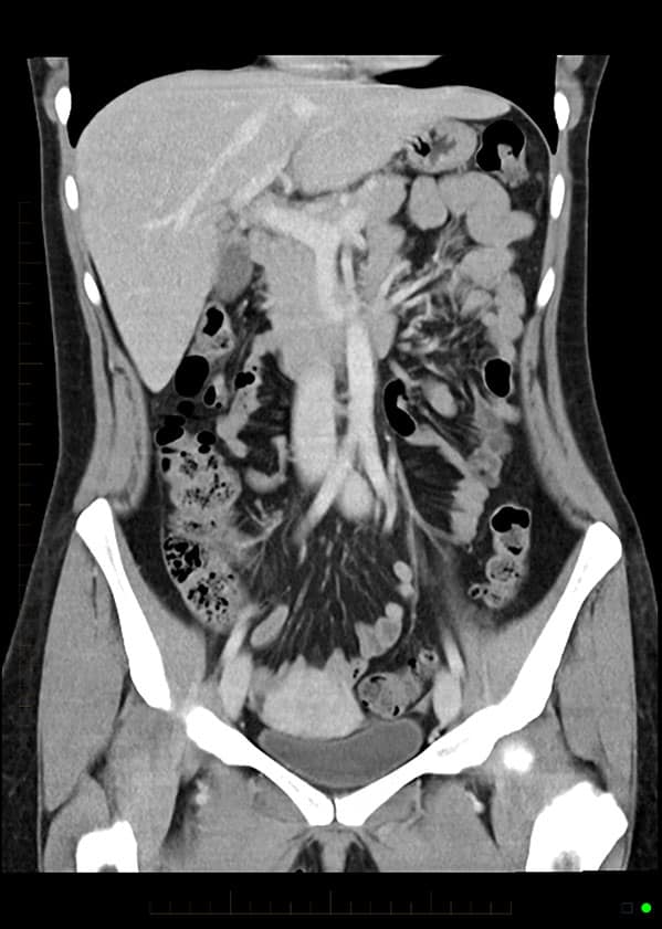 Ct Scan With Iv Contrast Patient Fact Sheet