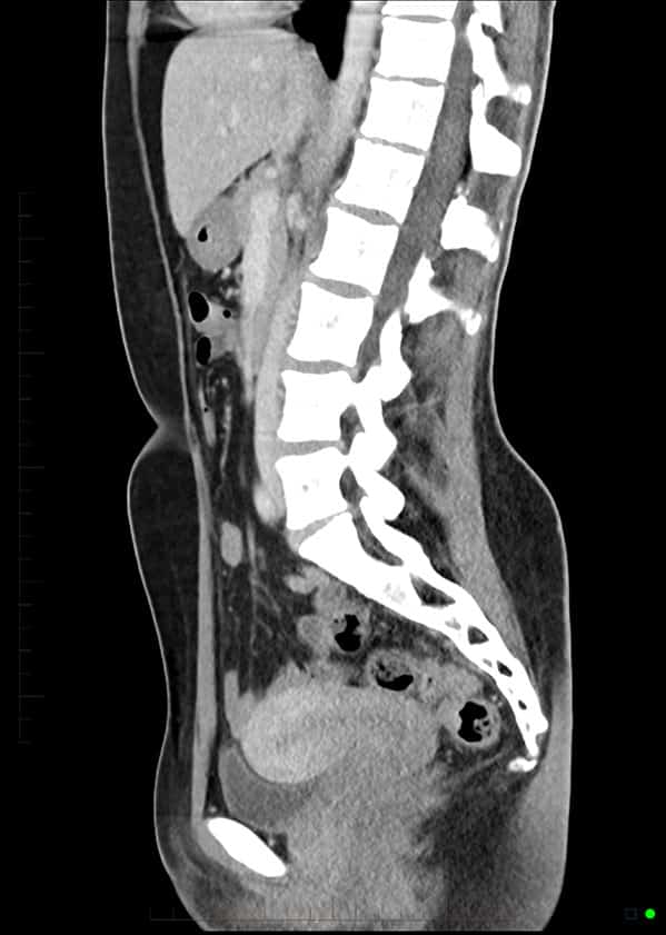 Ct Scan With Iv Contrast Patient Fact Sheet