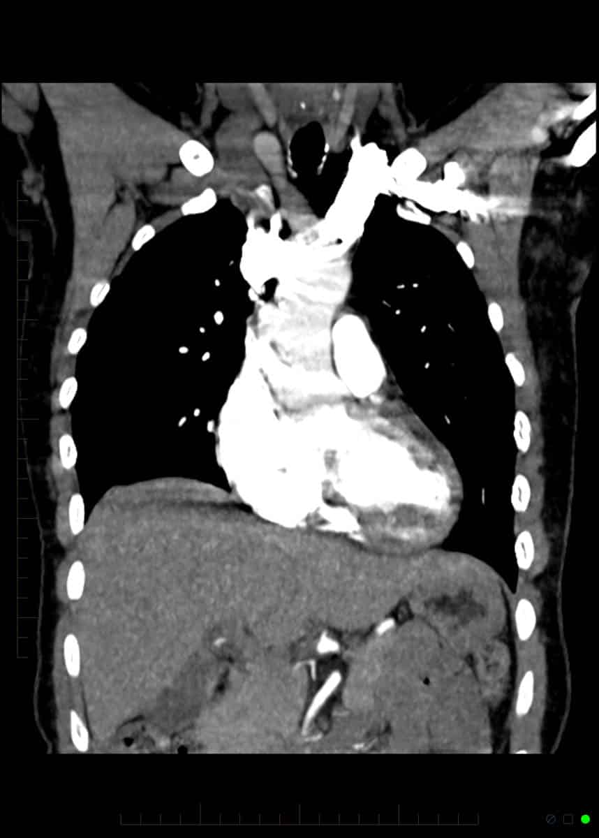 CT plumonary angiogram