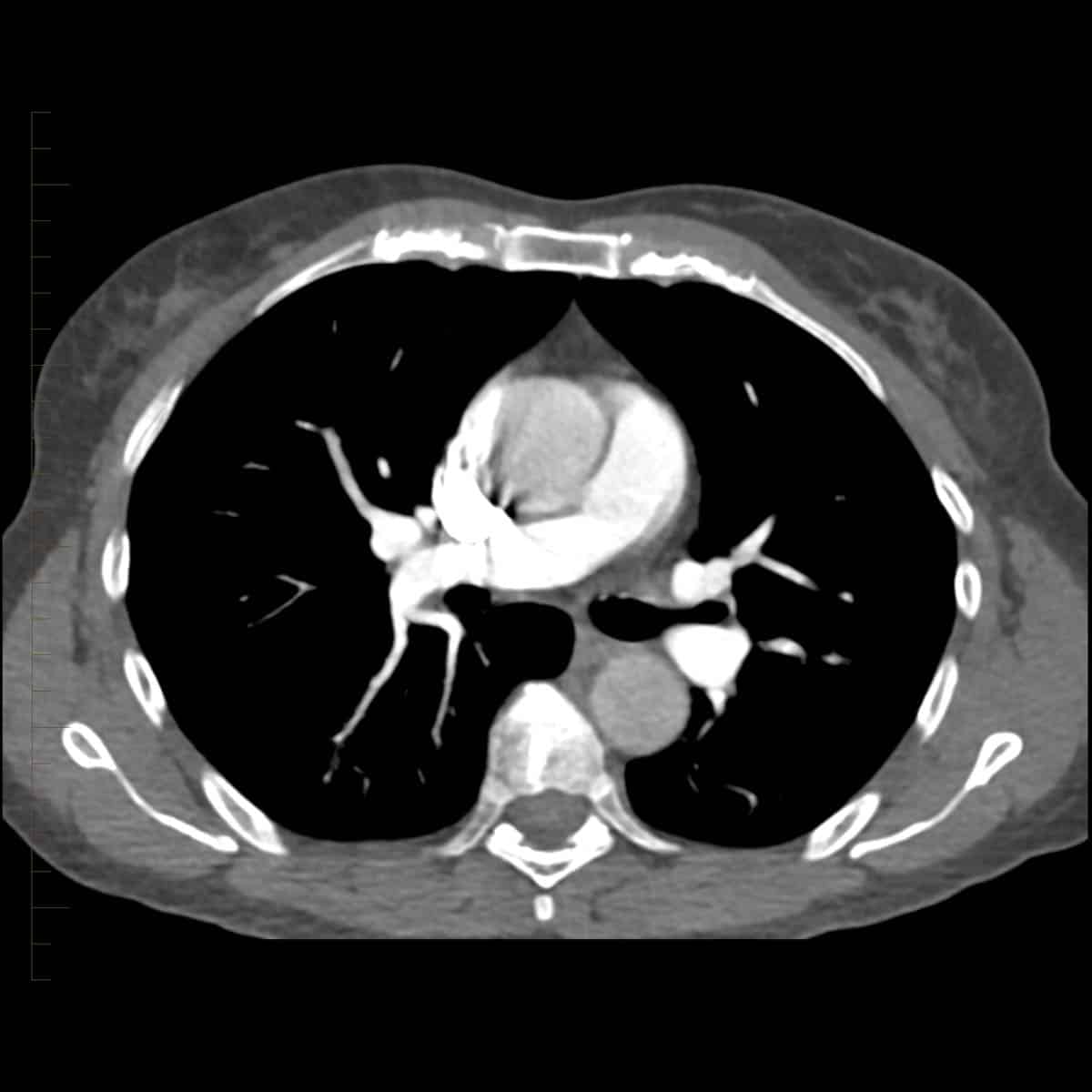 Ct Scan With Iv Contrast Patient Fact Sheet