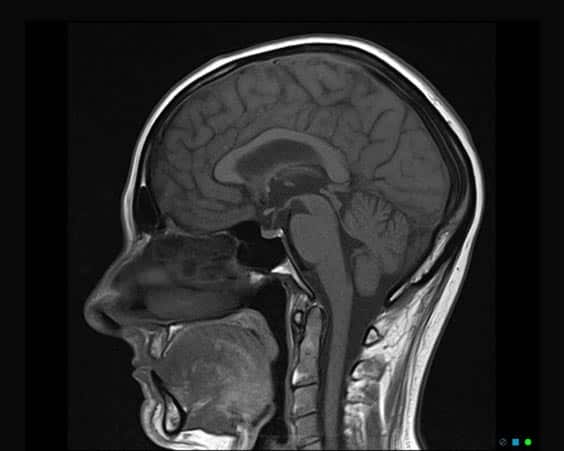 MRI Scan - Brain