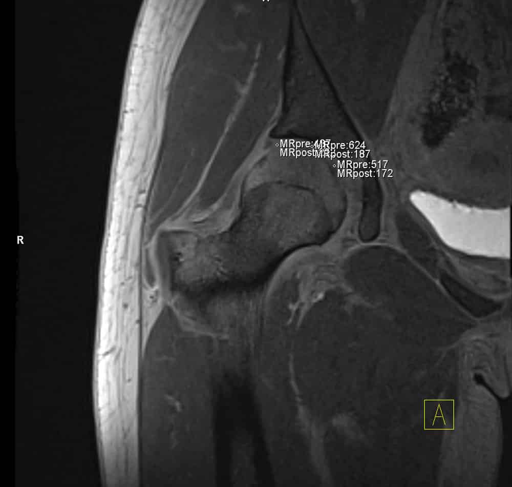 MRI scan of the hip