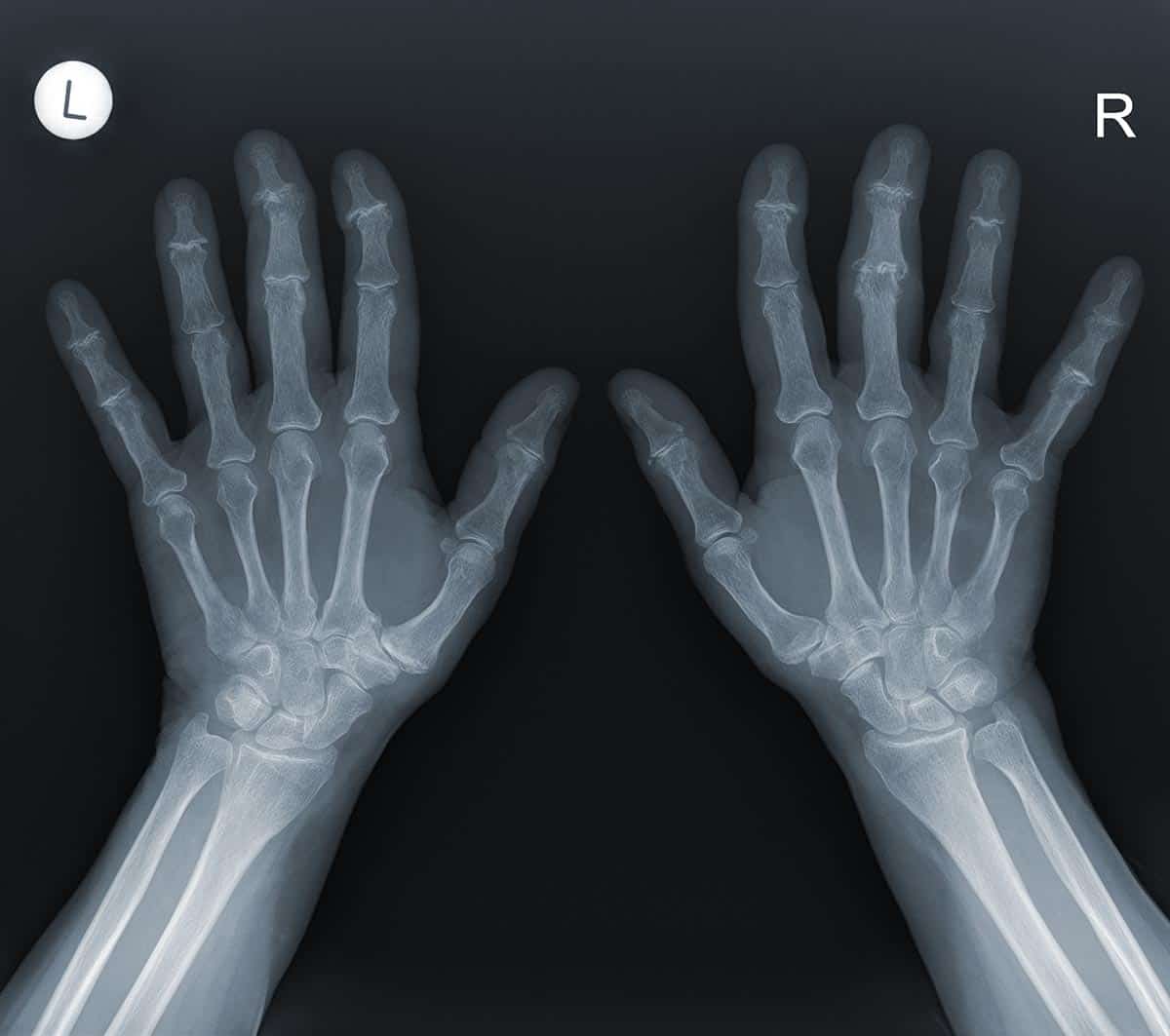 Hand X-Ray - Melbourne Radiology Clinic Hand X-Ray - Melbourne Radiology Clinic