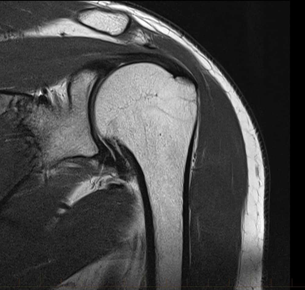 MRI of a shoulder rotator cuff