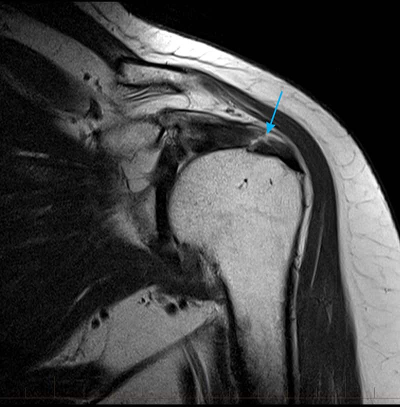 MRI of a supraspinatus tendon tear