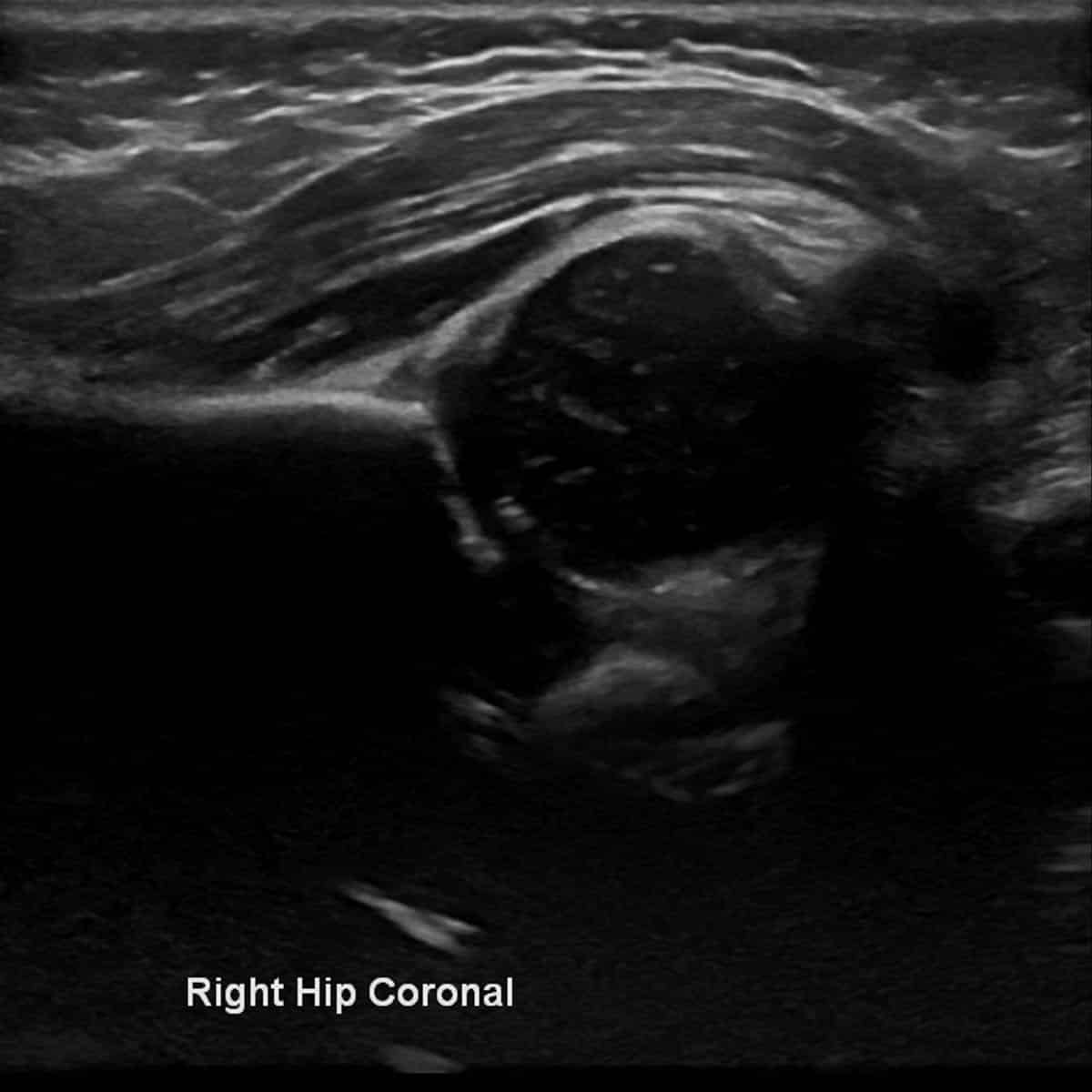 ultrasound of an infant's hip
