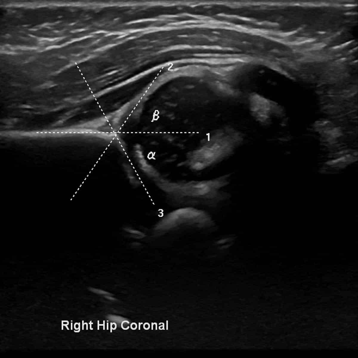 ultrasound of a right hip coronal