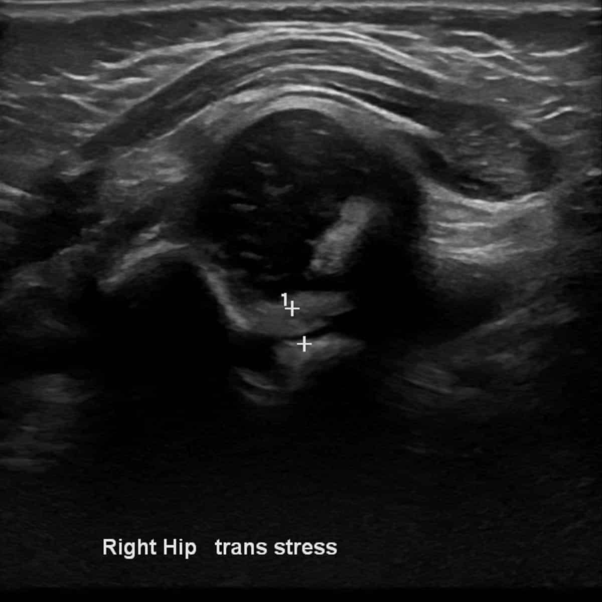 ultrasound of an infant's right hip