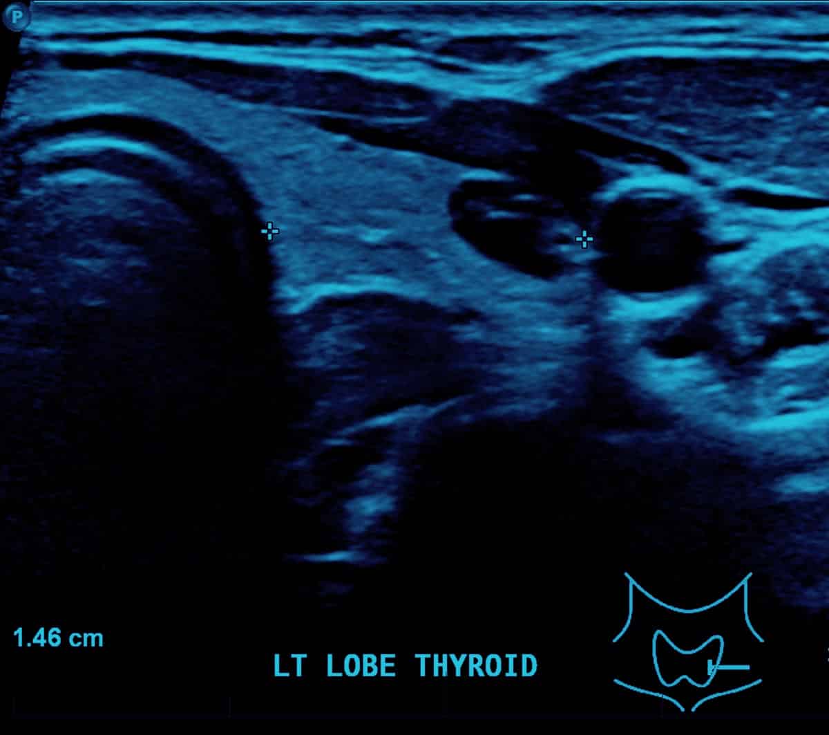 thyroid ultrasound