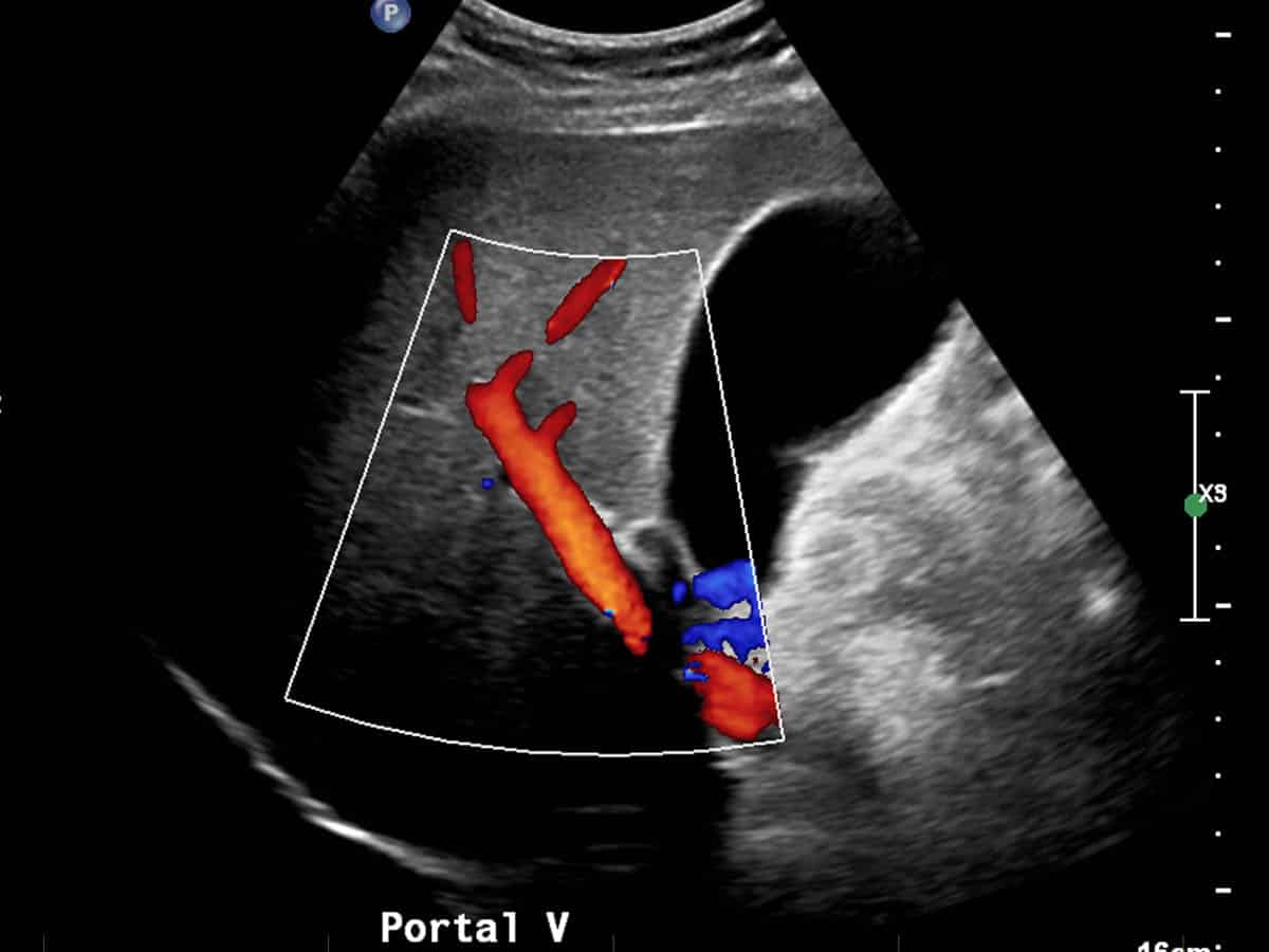 Ultrasound colour doppler examination of the liver demonstrates normal flow within the hepatic venous system (arrow).