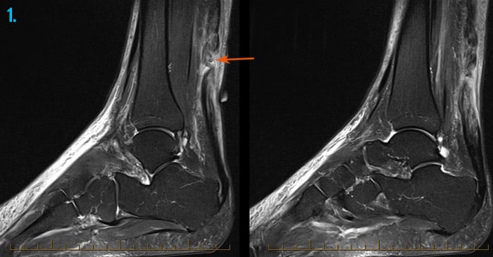 Spiritus Spytte mikrocomputer Foot & Ankle Injuries - Sports Imaging - Melbourne Radiology