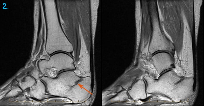 MRI scan showing foot fracture