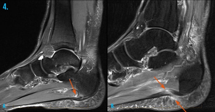 MRI images of an ankle