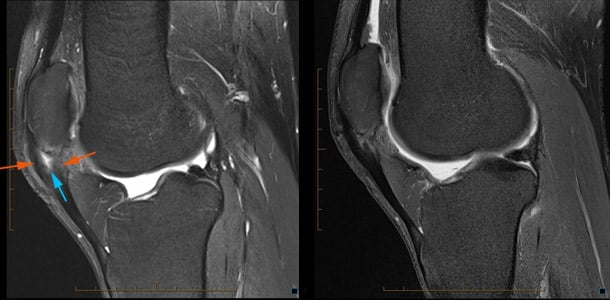Autologous Tendon Implantation Therapy - Figure A and B Autologous Tendon Implantation Therapy - Figure A and B