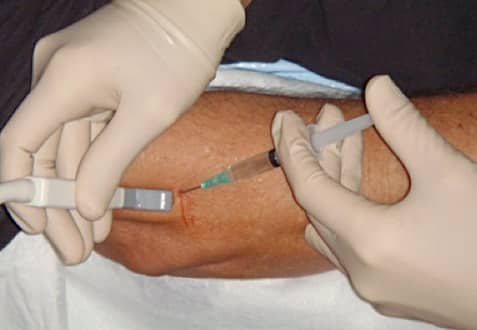 Autologous Tenocyte Implanation injection on a tendon