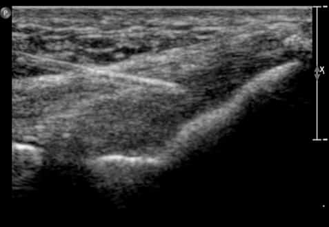 ultrasound scan of autologous tenocyte implantation