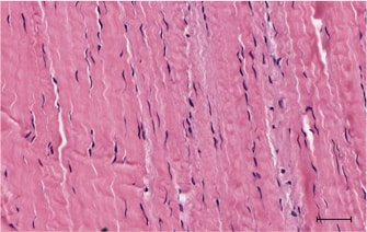 Figure 1 A. Microscopic slide showing normal tenocytes (blue ovoid spindle shape cells) surrounded by strands of dense collagen fibres which provide a tendon with its tensile strength. Figure 1 A. Microscopic slide showing normal tenocytes (blue ovoid spindle shape cells) surrounded by strands of dense collagen fibres which provide a tendon with its tensile strength.