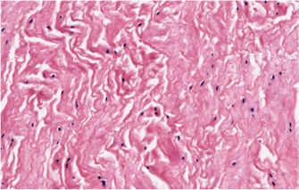 Figure 1B shows an abnormal tendon, where an abnormally low tenocyte population is evident with secondary disorganised collagen fibres.