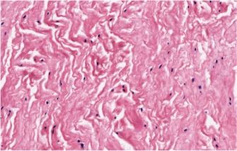 Figure 1B shows an abnormal tendon, where an abnormally low tenocyte population is evident with secondary disorganised collagen fibres. Figure 1B shows an abnormal tendon, where an abnormally low tenocyte population is evident with secondary disorganised collagen fibres.