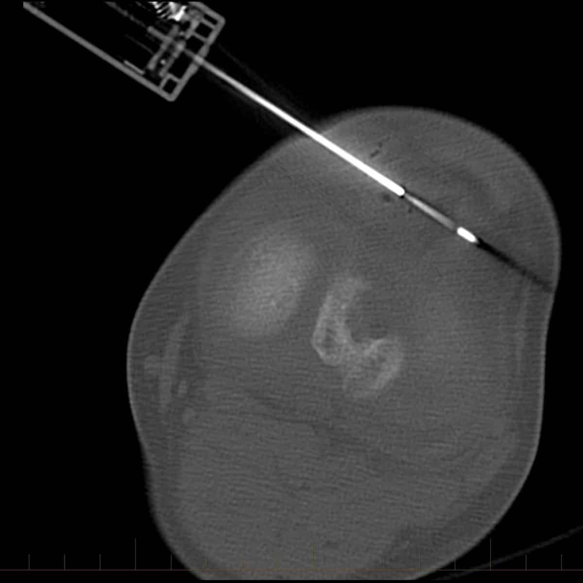 CT guided right knee soft tissue lesion biopsy CT guided right knee soft tissue lesion biopsy