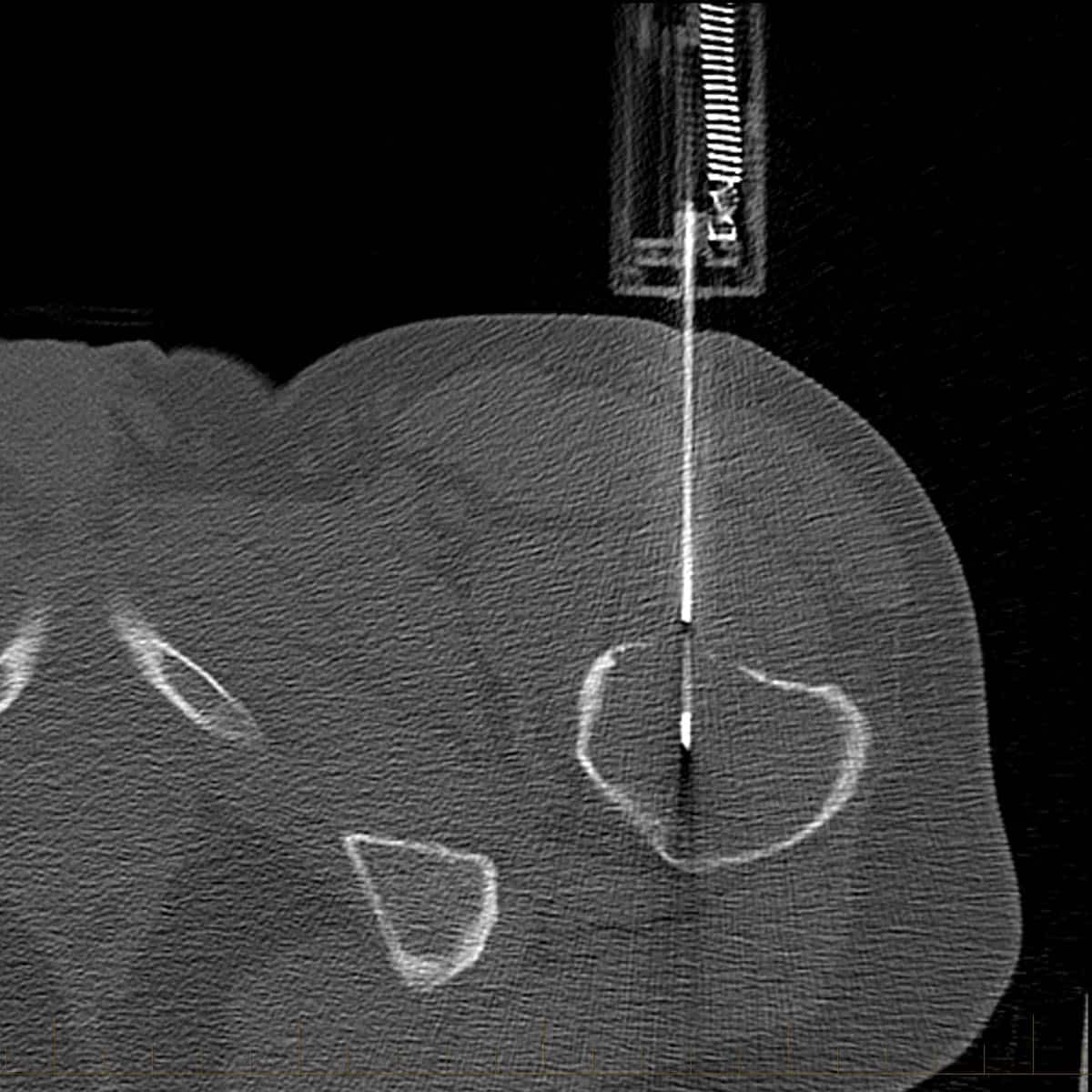 CT guided left femoral neck bone lesion biopsy CT guided left femoral neck bone lesion biopsy