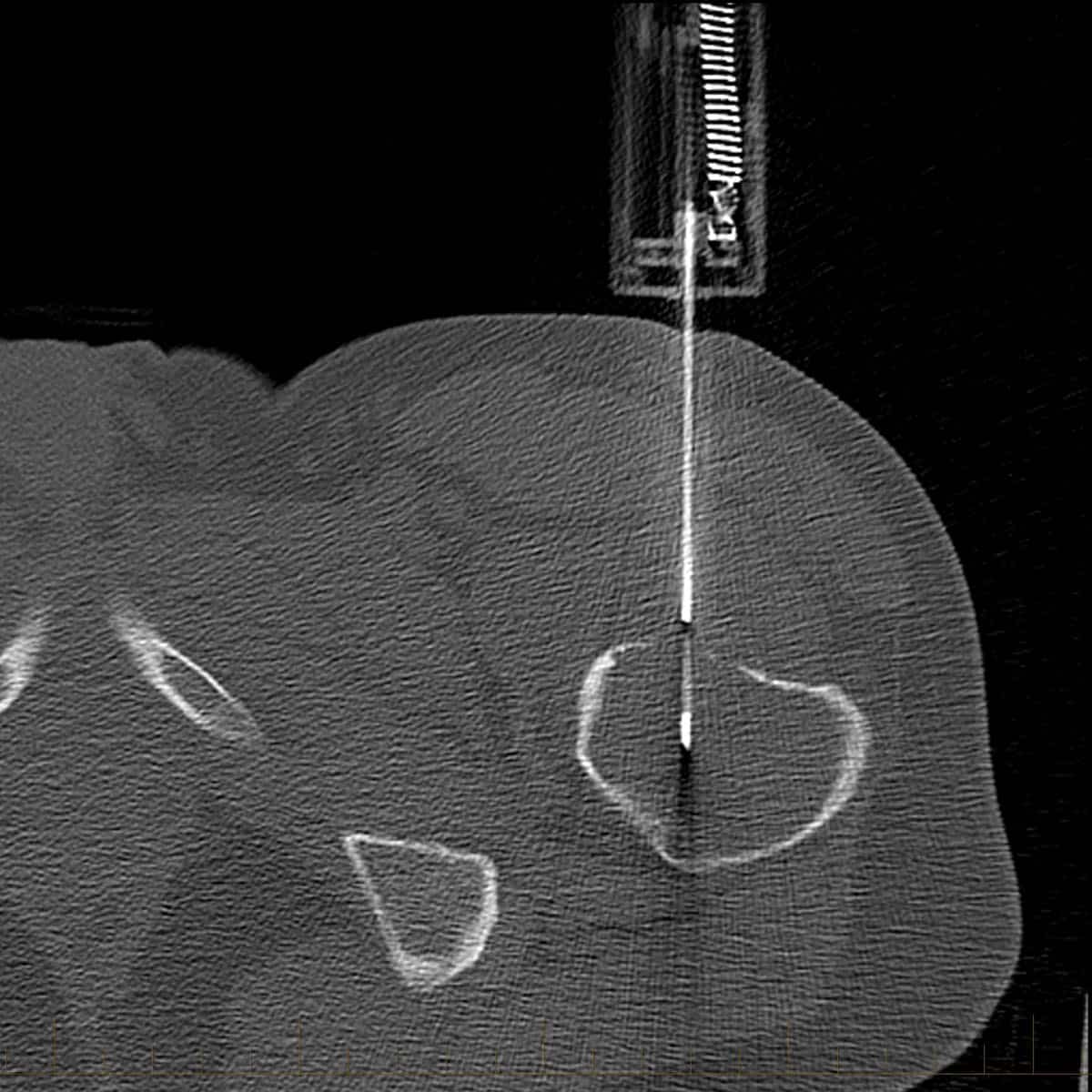 CT guided left femoral neck bone lesion biopsy