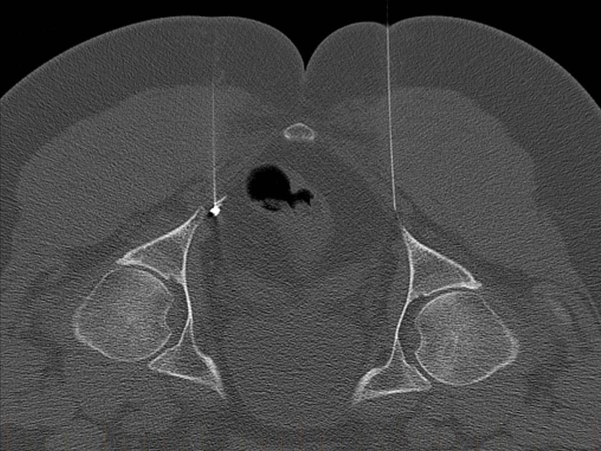 CT guided pudendal nerve block