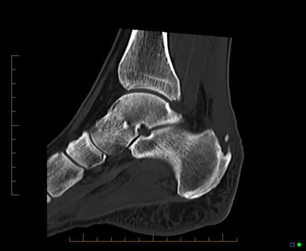 Foot Ankle Injuries Sports Imaging Melbourne Radiology