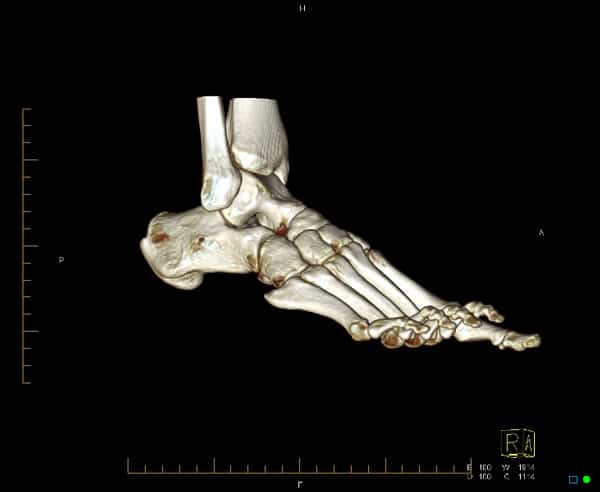 3B. 3D volume rendered CT examination of a normal right ankle.